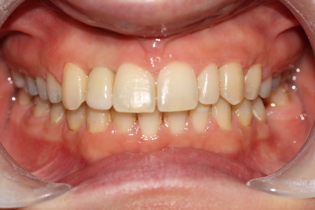 Teeth Straightening Bolton